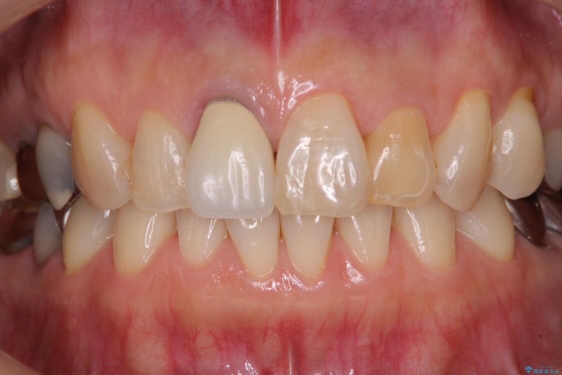 痛む奥歯と見栄えの悪い前歯　オールセラミックによる補綴治療 治療前