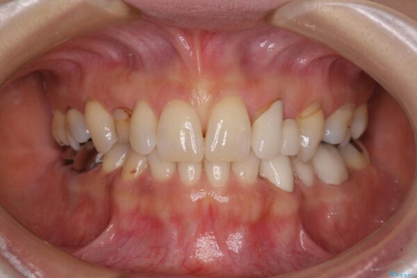 欠損の多い歯列　部分矯正とセラミックブリッジで自然な見た目に 治療前画像