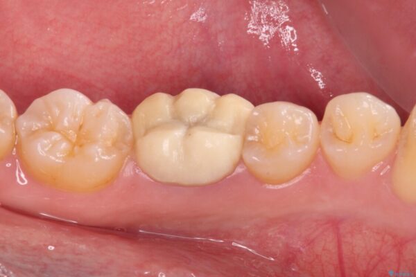 奥歯の被せものが汚れやすい　仮歯のままの歯をセラミッククラウンに 治療前画像