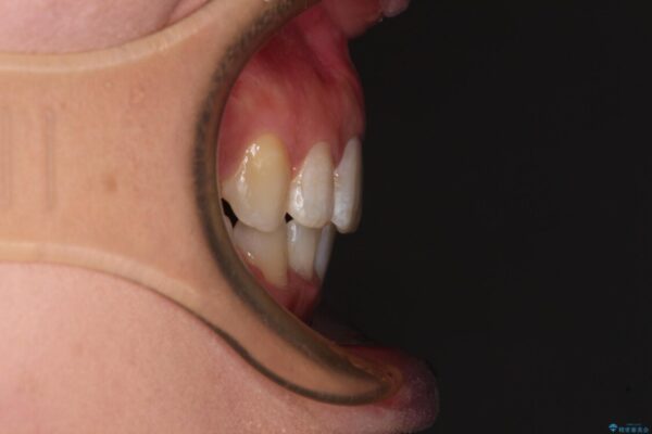 インビザラインが続けられない　ワイヤー装置による抜歯矯正 アフター