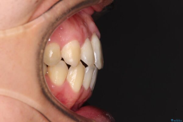 咬み合わせが気になる　ワイヤー矯正による咬み合わせ改善と奥歯のセラミック治療 アフター