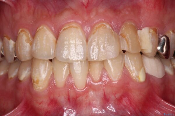 むし歯の影響で、前歯を見せることが恥ずかしいとのことで来院された患者様です。 治療前画像