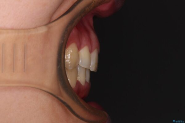 前歯のデコボコを短期間で解消　ワイヤー装置による抜歯矯正 治療後画像