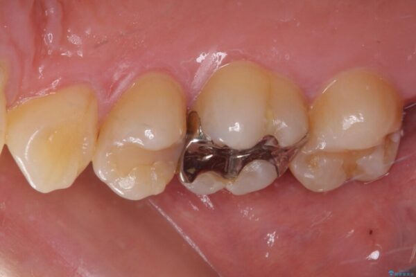 奥歯がしみる　むし歯と知覚過敏の補綴治療　 治療前画像
