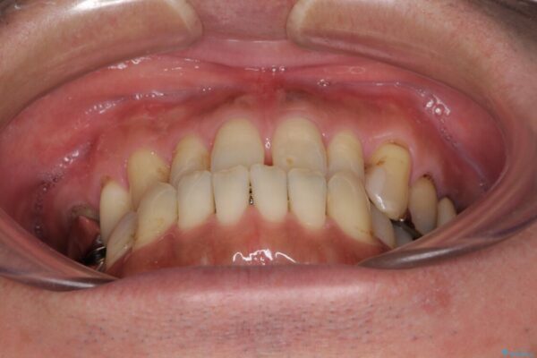 前歯の反対咬合をワイヤー矯正で改善して噛みやすく 治療前画像