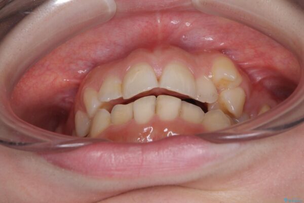 顕著な八重歯をインビザラインで治せるところまで改善 治療前画像