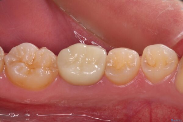 奥歯の被せものが汚れやすい　仮歯のままの歯をセラミッククラウンに 治療後画像