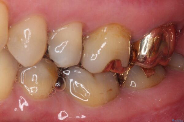 奥歯が外れた　ゴールドクラウンによる補綴治療 治療後画像