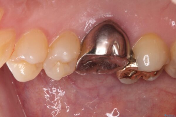 穴の空いてしまった奥歯　ゴールドインレーによるむし歯治療 治療後画像