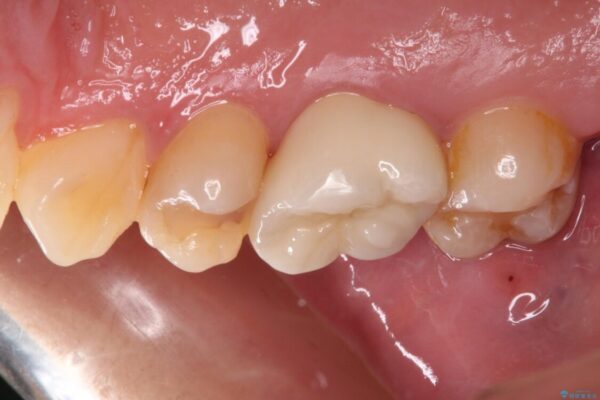 奥歯がしみる　むし歯と知覚過敏の補綴治療　 治療後画像