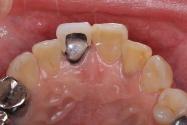 痛む奥歯と見栄えの悪い前歯　オールセラミックによる補綴治療 治療前画像