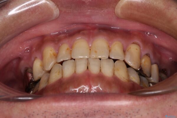 前歯の反対咬合をワイヤー矯正で改善して噛みやすく 治療後画像