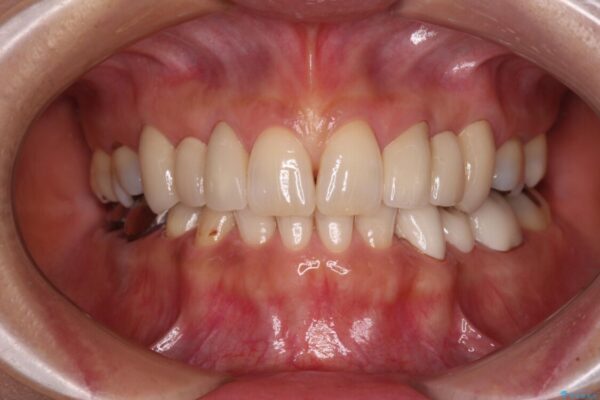 欠損の多い歯列　部分矯正とセラミックブリッジで自然な見た目に 治療後画像