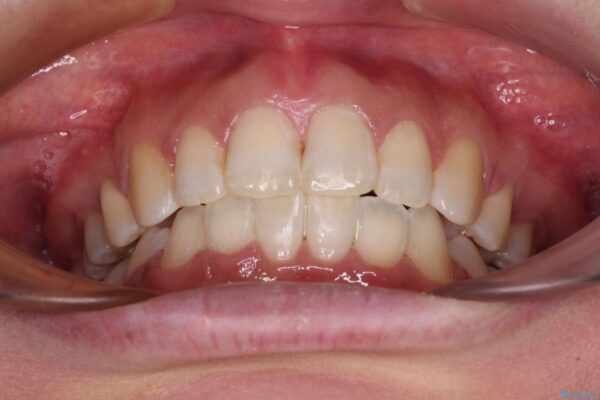 インビザラインが続けられない　ワイヤー装置による抜歯矯正 治療後画像