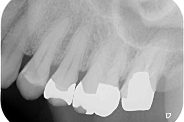 奥歯が外れた　ゴールドクラウンによる補綴治療 治療前画像