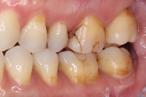 しみる奥歯　セラミッククラウンによるむし歯治療 治療前画像