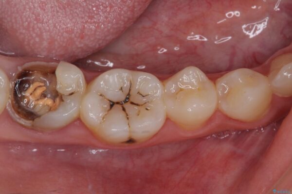 むし歯だらけの奥歯　セラミッククラウンによるむし歯治療 治療前画像