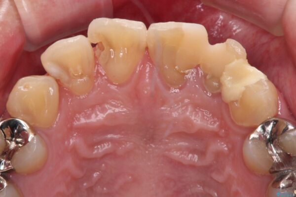 むし歯の影響で、前歯を見せることが恥ずかしいとのことで来院された患者様です。 治療前画像