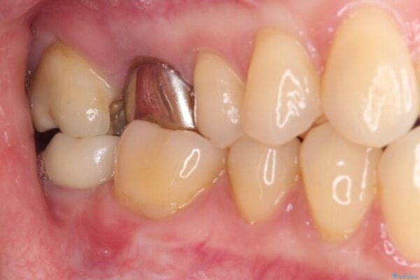 穴の空いてしまった奥歯　ゴールドインレーによるむし歯治療 治療前画像