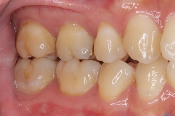 奥歯がしみる　むし歯と知覚過敏の補綴治療　 治療前画像