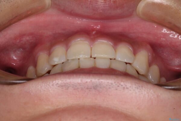 隙間の空いた前歯を治したい　上顎の部分矯正 治療後画像