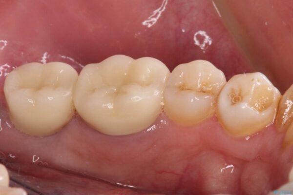 抜歯が必要な奥歯　ストローマン・インプラント補綴治療 治療後画像