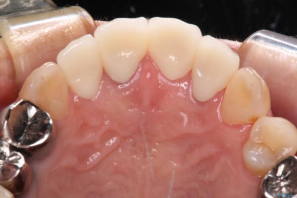 痛む奥歯と見栄えの悪い前歯　オールセラミックによる補綴治療 治療後画像