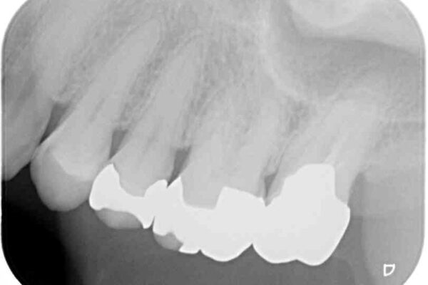 奥歯が外れた　ゴールドクラウンによる補綴治療 治療後画像