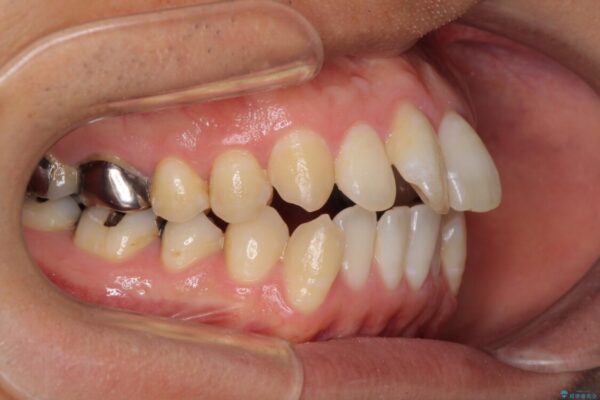 咬み合わせが気になる　ワイヤー矯正による咬み合わせ改善と奥歯のセラミック治療 治療前画像