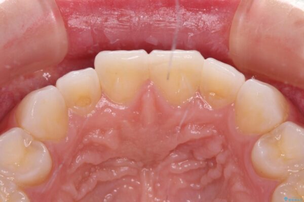 前歯の形を変えたい　前歯のラミネートベニア治療 治療後画像