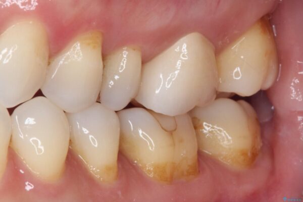 しみる奥歯　セラミッククラウンによるむし歯治療 治療後画像