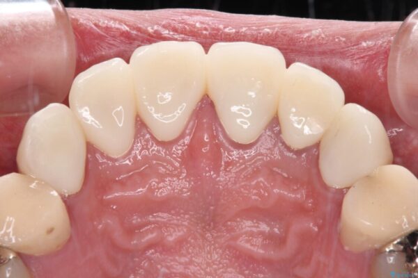 むし歯の影響で、前歯を見せることが恥ずかしいとのことで来院された患者様です。 治療後画像