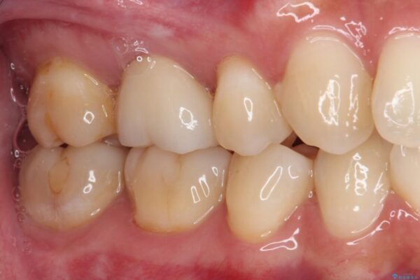 奥歯がしみる　むし歯と知覚過敏の補綴治療　 治療後画像