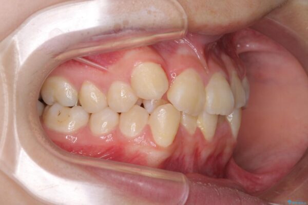八重歯で正中が右にずれている　ワイヤー装置での抜歯矯正で正中位置を改善 治療前画像