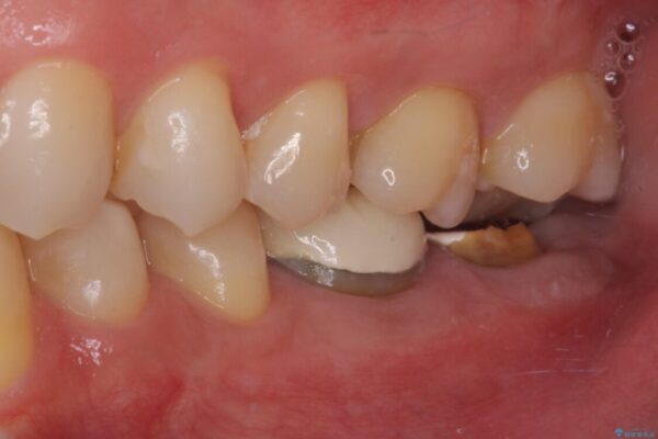 抜歯が必要な奥歯　ストローマン・インプラント補綴治療 治療前画像