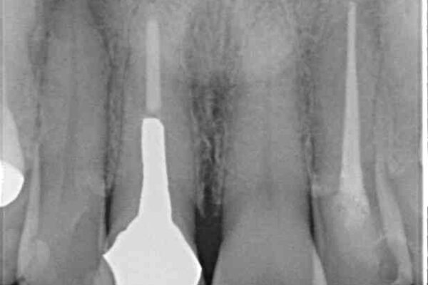 痛む奥歯と見栄えの悪い前歯　オールセラミックによる補綴治療 治療前画像