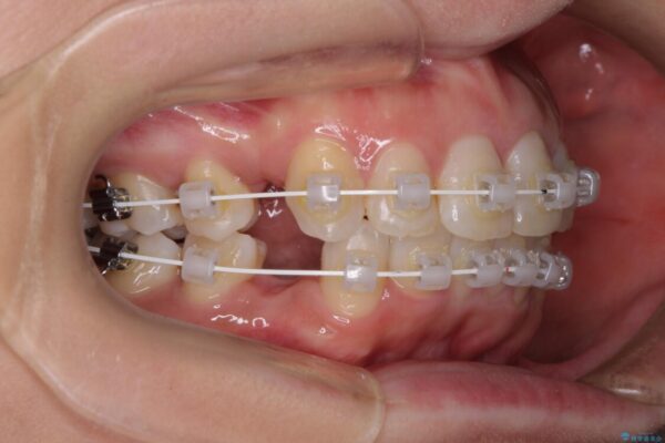インビザラインが続けられない　ワイヤー装置による抜歯矯正 治療途中画像