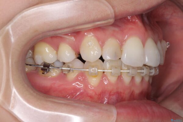 目立たないハーフリンガル矯正　抜歯矯正で口元を改善 治療途中画像