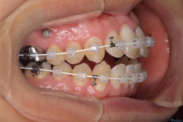 咬み合わせが気になる　ワイヤー矯正による咬み合わせ改善と奥歯のセラミック治療 治療途中画像