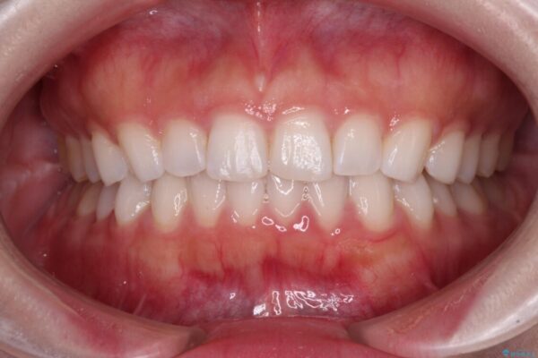 前歯の形を変えたい　前歯のラミネートベニア治療 治療前画像