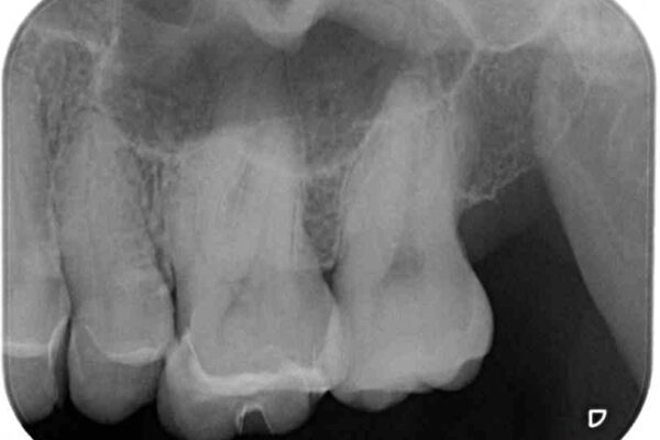 しみる奥歯　セラミッククラウンによるむし歯治療 治療前画像