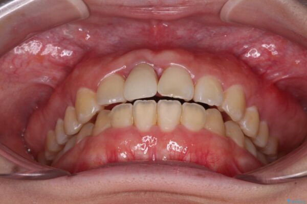 怪我をして不格好な前歯　矯正治療とインプラント補綴治療 治療後画像