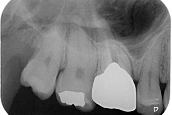 穴の空いてしまった奥歯　ゴールドインレーによるむし歯治療 治療前画像