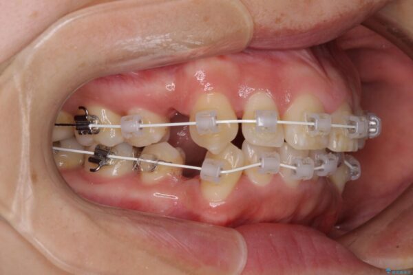前歯のデコボコを短期間で解消　ワイヤー装置による抜歯矯正 治療途中画像