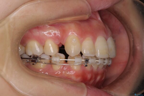 突出した口元が気になる　ハーフリンガル装置による抜歯矯正 治療途中画像