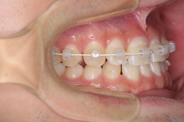 隙間の空いた前歯を治したい　上顎の部分矯正 治療途中画像