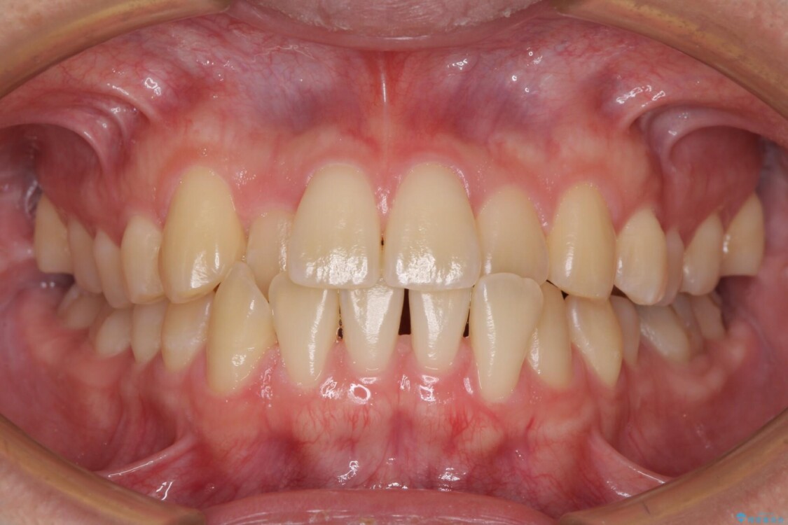 【モニター】前歯のクロスバイトと隙間を改善　インビザラインによる矯正治療 治療前