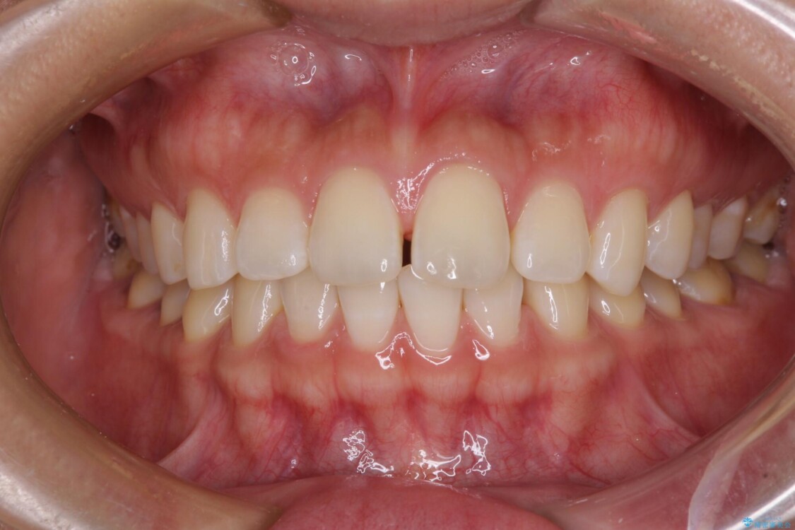 【モニター】前歯のすきっ歯をインビザラインで改善 治療前