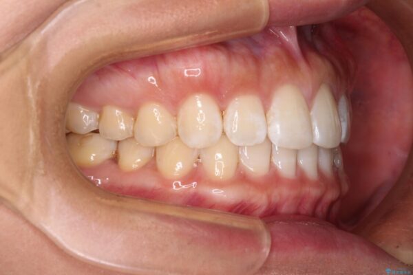 【モニター】前歯のすきっ歯をインビザラインで改善 治療後画像