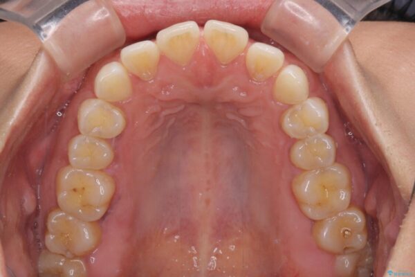 【モニター】前歯のすきっ歯をインビザラインで改善 治療前画像